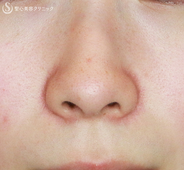【20代女性・鼻の穴が正面から見える】小鼻縮小術+α法（1年3ヶ月後）札幌院 Before 