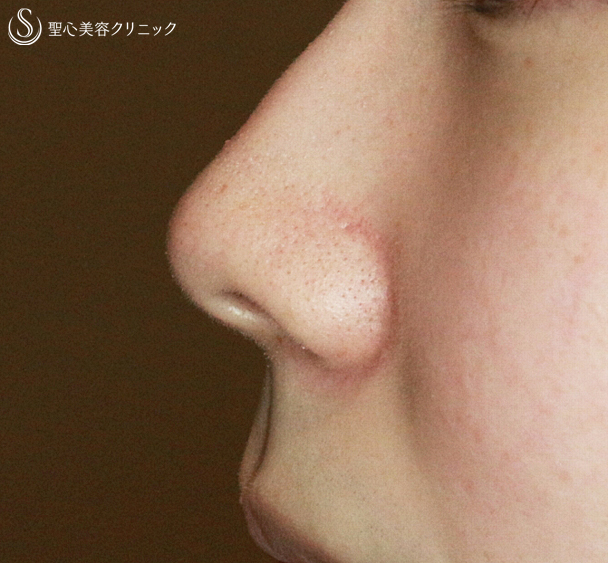 【20代女性・鼻の穴が正面から見える】小鼻縮小術+α法（1年3ヶ月後）札幌院 Before 