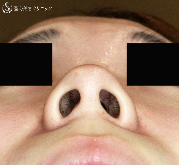 【20代女性・鼻の穴が正面から見える】小鼻縮小術+α法（1年3ヶ月後）札幌院 Before 