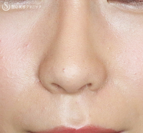 【20代女性・鼻の穴が正面から見える】小鼻縮小術+α法（1年3ヶ月後）札幌院 After 