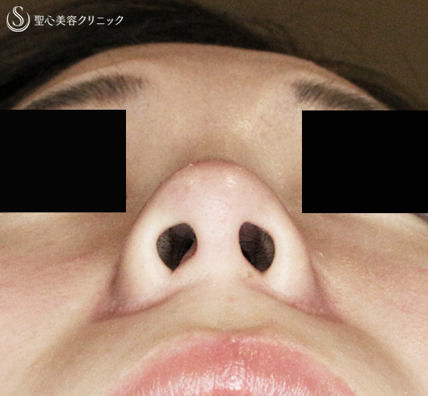 【20代女性・鼻の穴が正面から見える】小鼻縮小術+α法（1年3ヶ月後）札幌院 After 