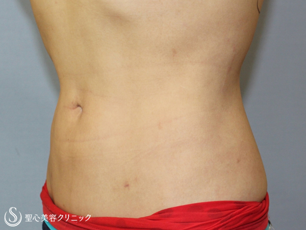 【30代女性・ウエストを細く】腹部ベイザー脂肪吸引（他院脂肪吸引後） After 