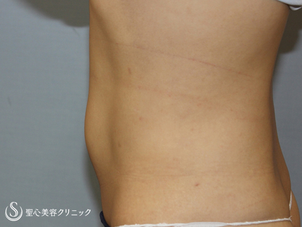 【30代女性・ウエストを細く】腹部ベイザー脂肪吸引（他院脂肪吸引後） Before 
