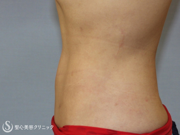 【30代女性・ウエストを細く】腹部ベイザー脂肪吸引（他院脂肪吸引後） After 