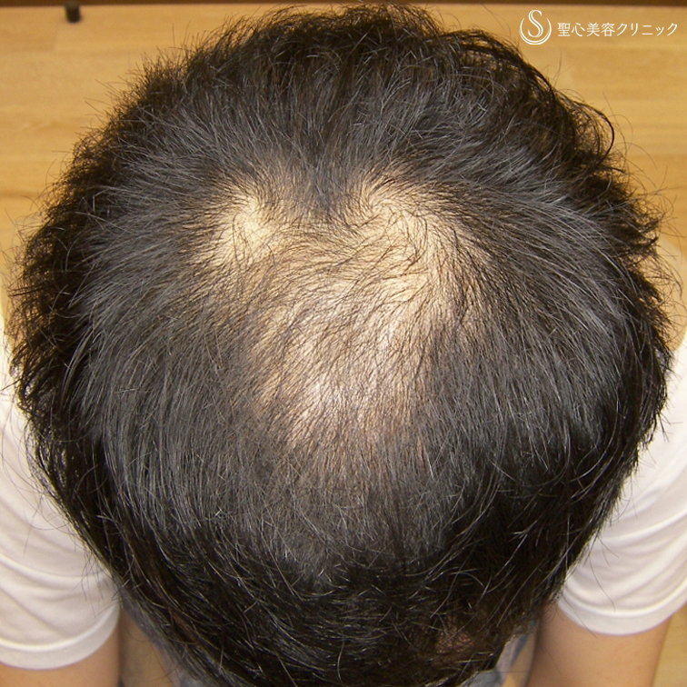 【20代男性・AGAによる薄毛】グロースファクター毛髪再生療法（8回後） Before 