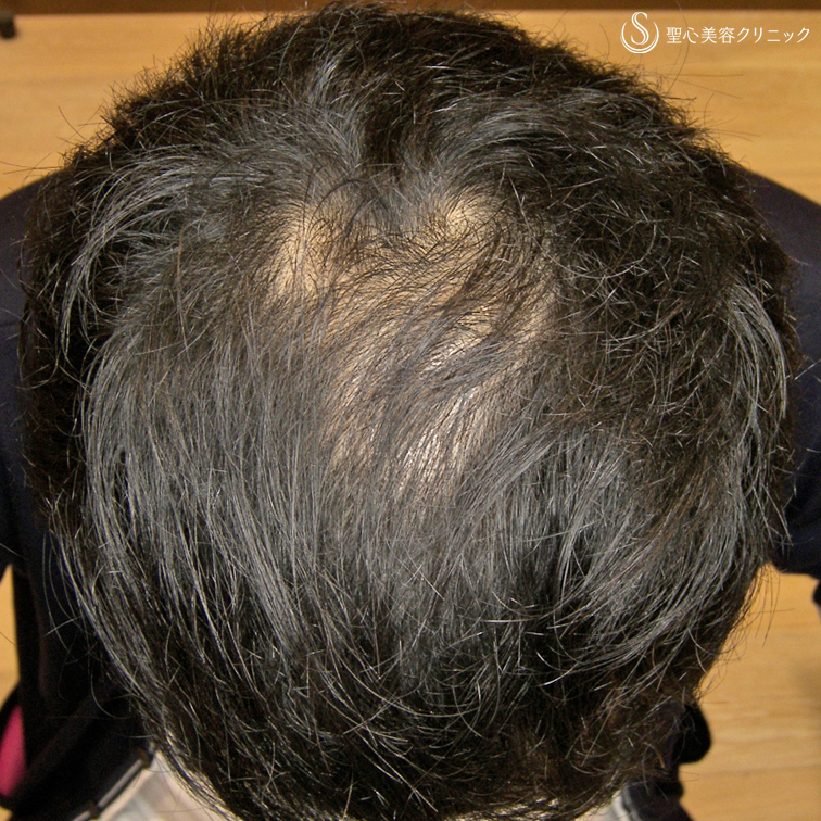 【20代男性・AGAによる薄毛】グロースファクター毛髪再生療法（8回後） After 