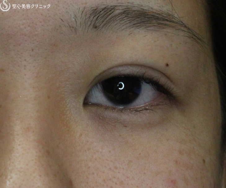【20代女性・腫れは最低限】腫れにくい二重術　マイクロメソッド＋α（術直後） After 