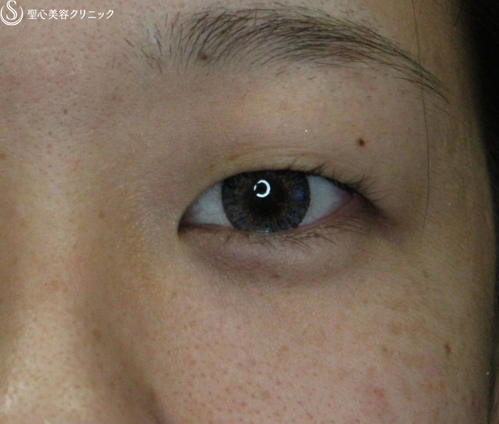 【20代女性・腫れは最低限】腫れにくい二重術　マイクロメソッド＋α（術直後） Before 