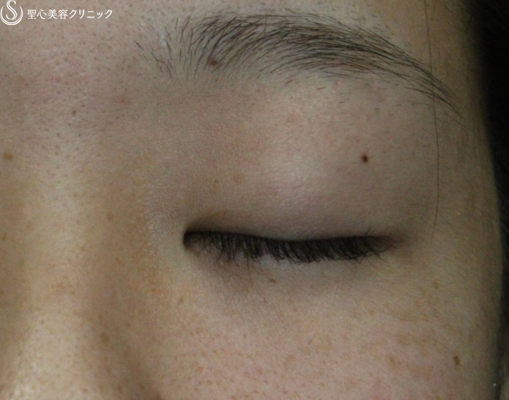 【20代女性・腫れは最低限】腫れにくい二重術　マイクロメソッド＋α（術直後） Before 