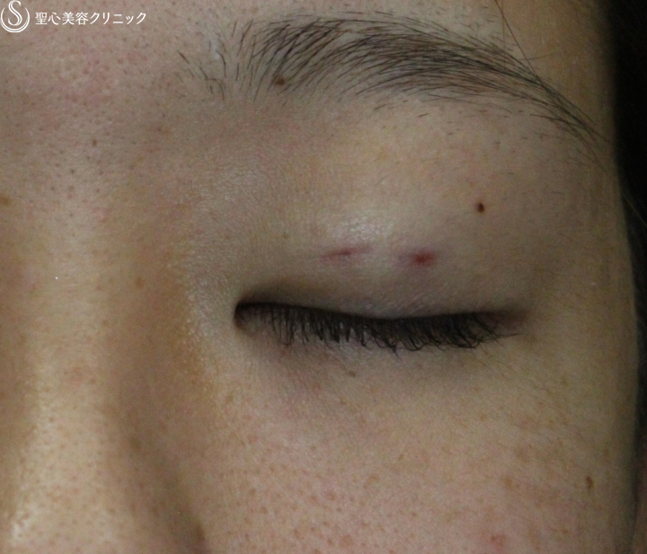 【20代女性・腫れは最低限】腫れにくい二重術　マイクロメソッド＋α（術直後） After 