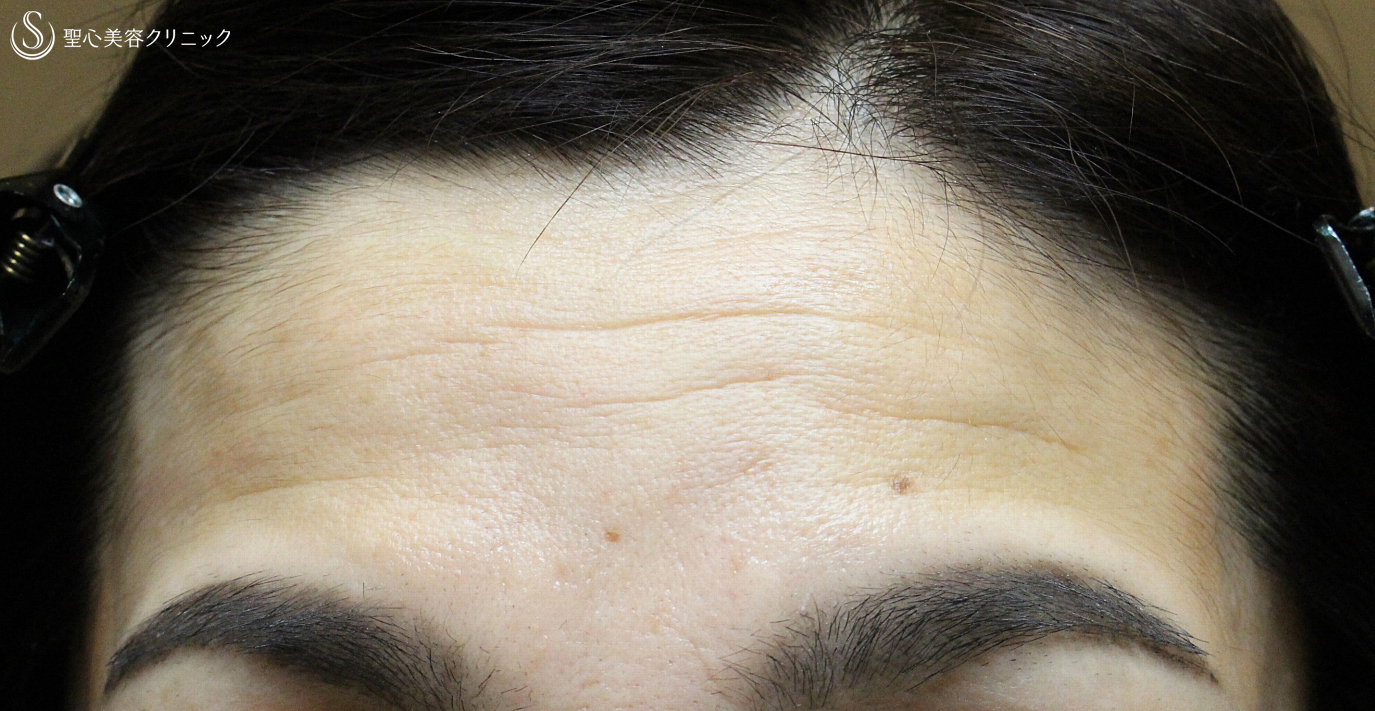 【40代女性・額のシワと凹凸を注入で長期経過】プレミアムPRP皮膚再生療法（7年後） Before 