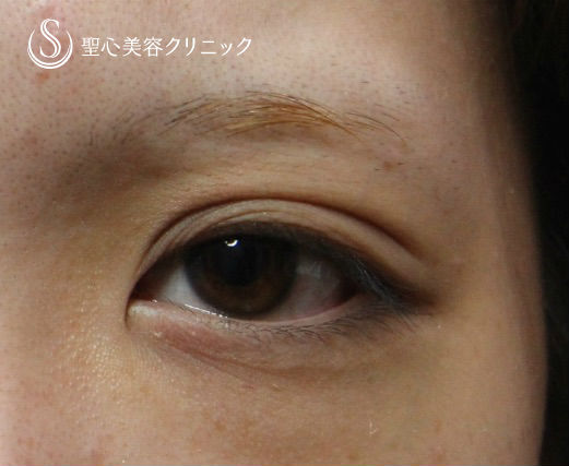 【20代女性・平行二重に】目頭切開 Before 