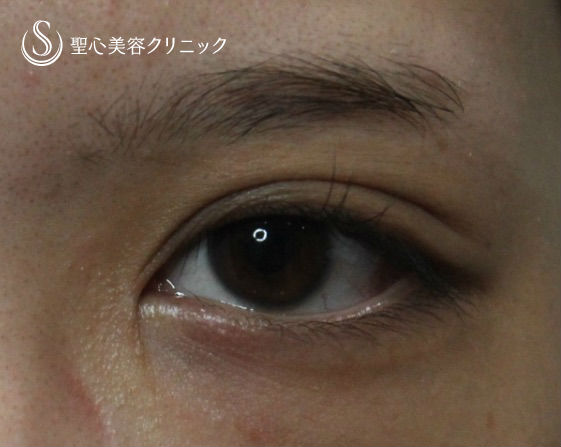 【20代女性・平行二重に】目頭切開 After 