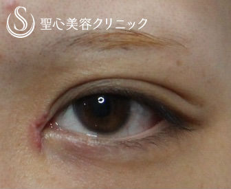 【20代女性・平行二重に】目頭切開 After 