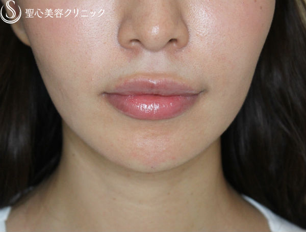 【20代女性・フェイスラインをスッキリと】クレヴィエル・コントア（施術直後） After 