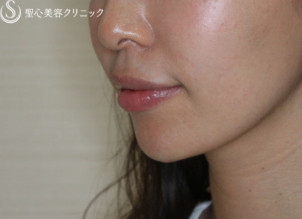 【20代女性・フェイスラインをスッキリと】クレヴィエル・コントア（施術直後） After 