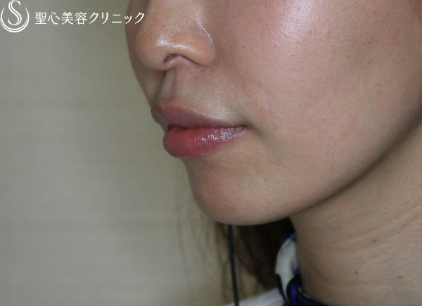 【20代女性・フェイスラインをスッキリと】クレヴィエル・コントア（施術直後） Before 