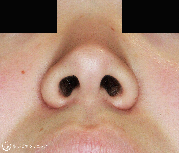 【20代女性・小鼻の広がり+鼻の穴が見える】小鼻縮小術+α法（11 ...