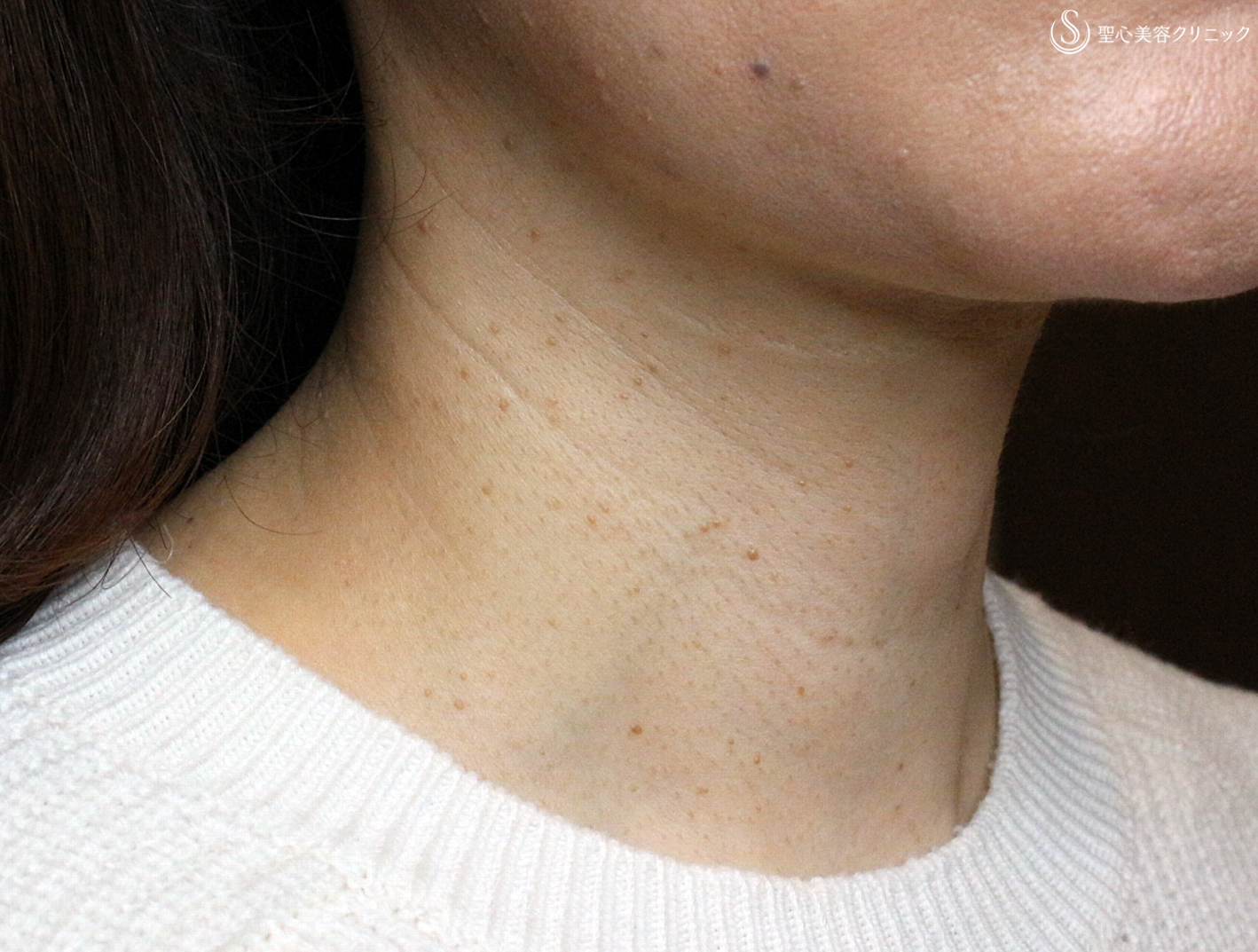 【50代女性・首の横ジワの長期経過】プレミアムPRP皮膚再生療法（10年後） Before 