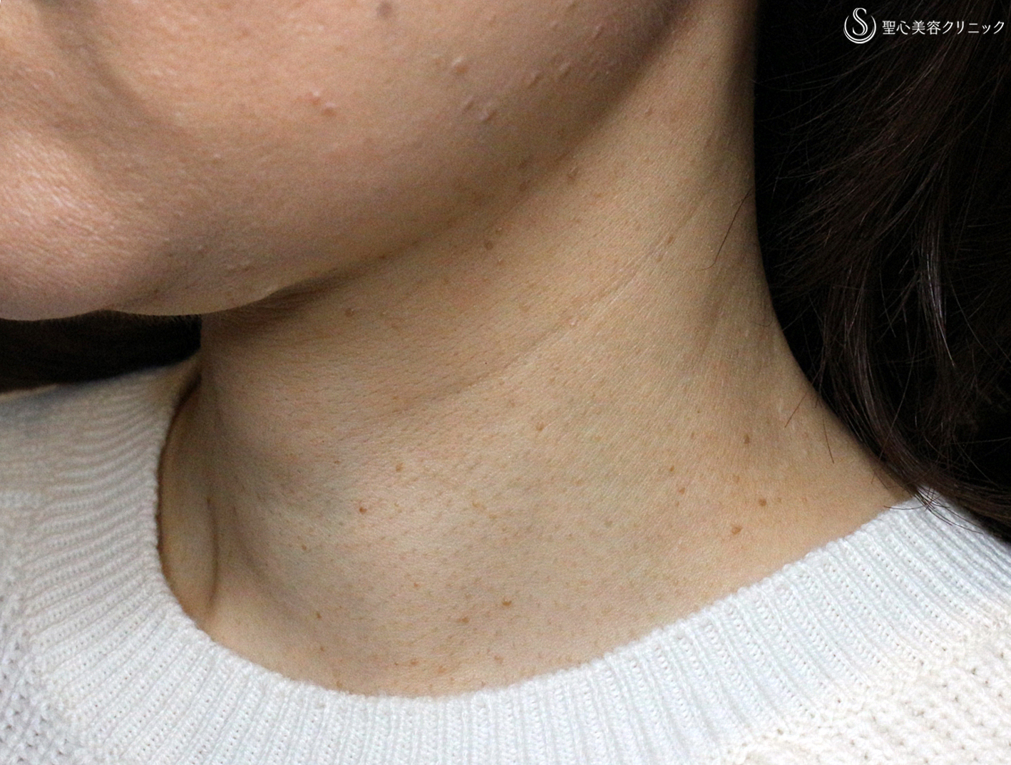 【50代女性・首の横ジワの長期経過】プレミアムPRP皮膚再生療法（10年後） Before 