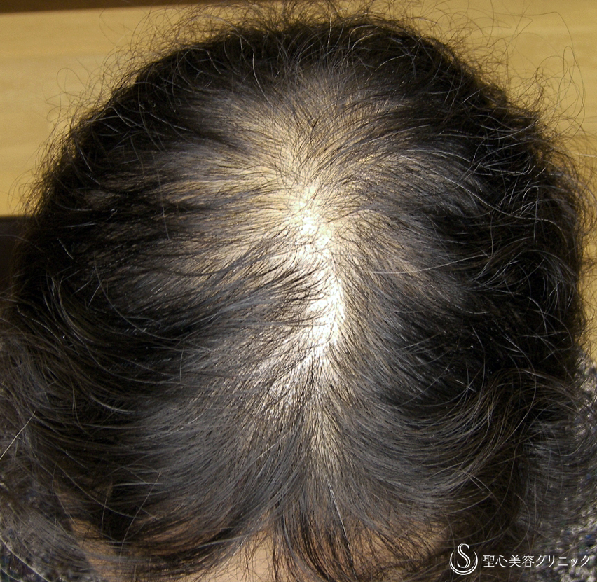 【60代女性・びまん性脱毛】プレミアムグロースファクター療法（16回後） Before 