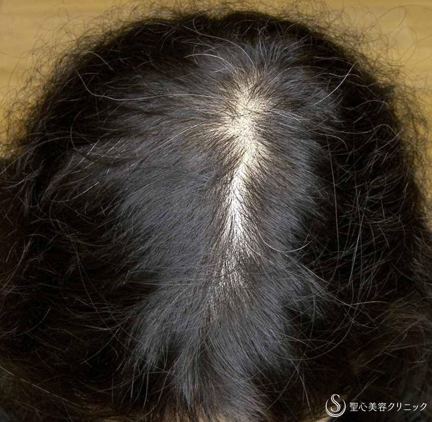 【60代女性・びまん性脱毛】プレミアムグロースファクター療法（16回後） After 