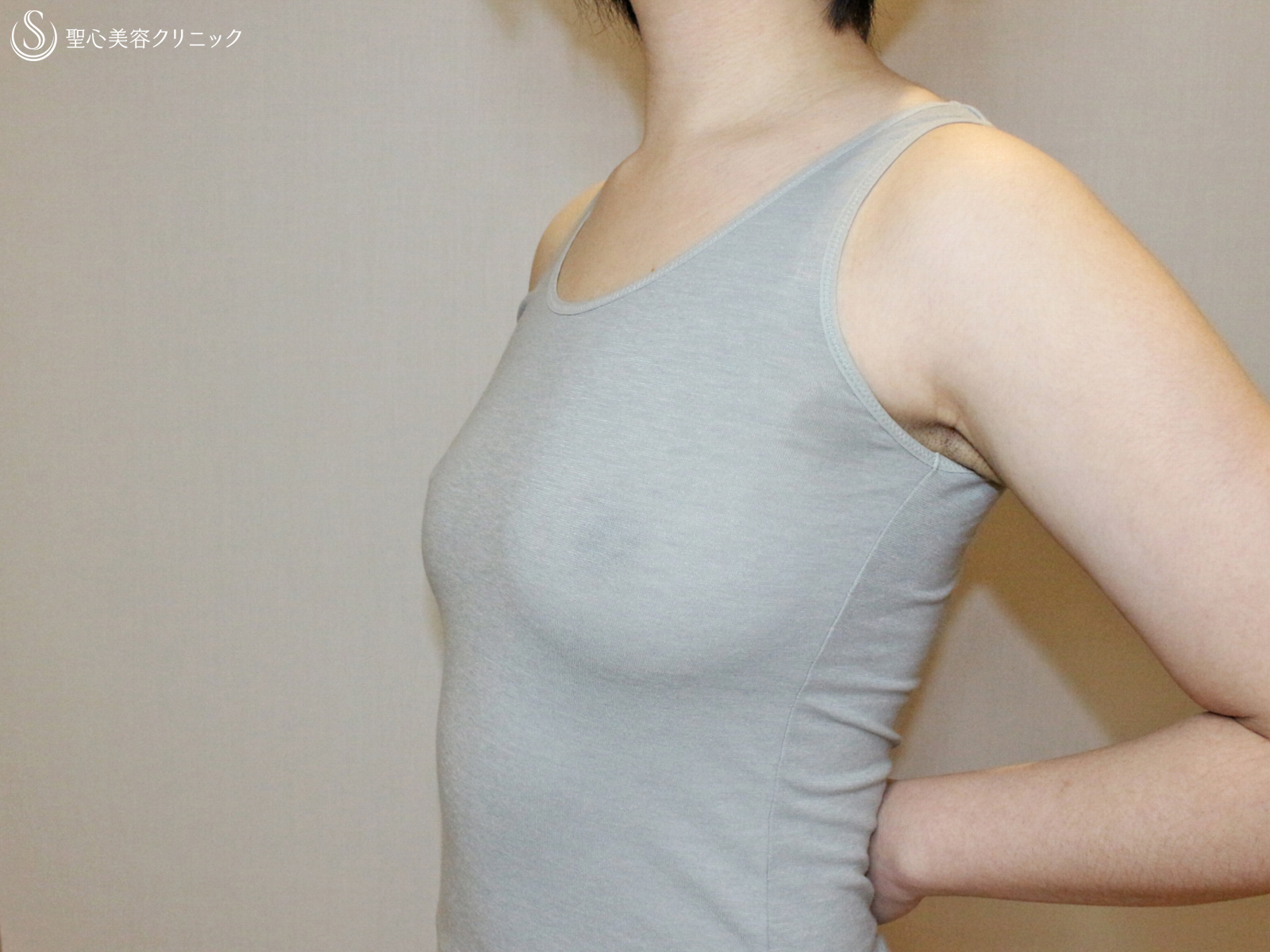 【34歳・性同一性障害（FTM）】乳腺切除+ベイザー脂肪吸引（1ヶ月後） Before 