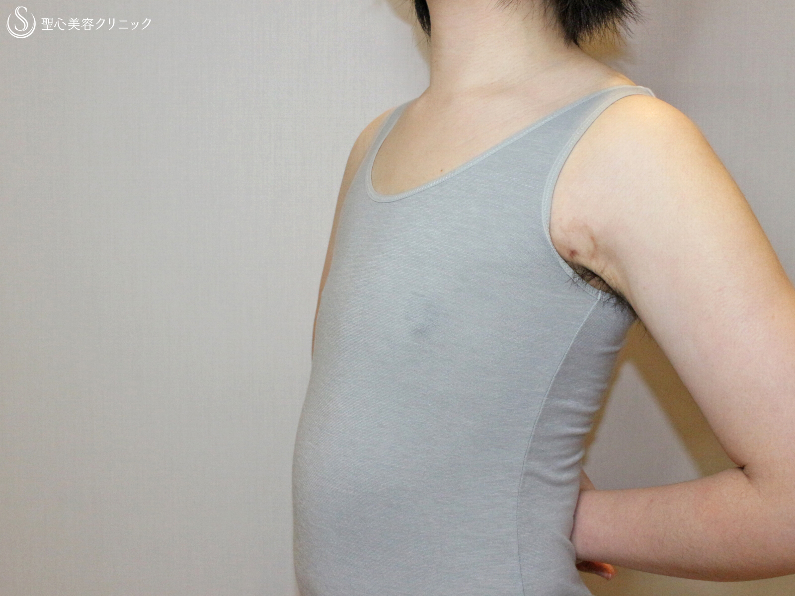【34歳・性同一性障害（FTM）】乳腺切除+ベイザー脂肪吸引（1ヶ月後） After 