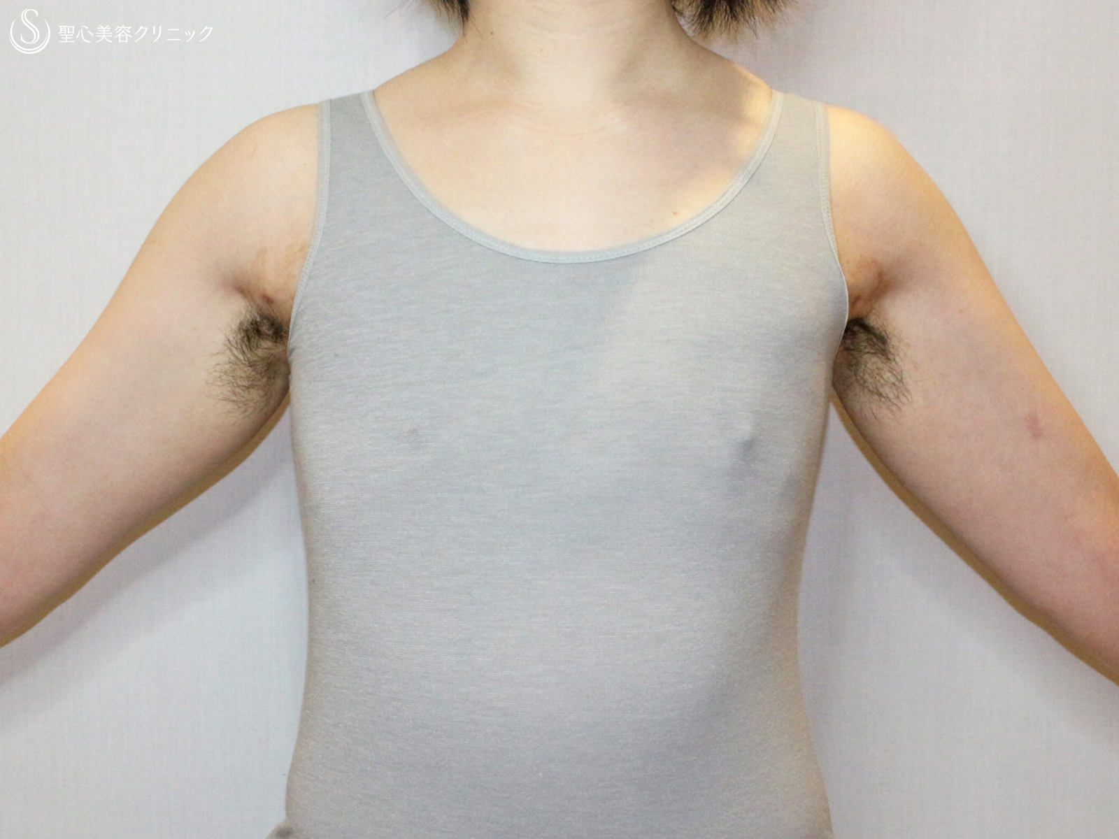 【34歳・性同一性障害（FTM）】乳腺切除+ベイザー脂肪吸引（1ヶ月後） After 
