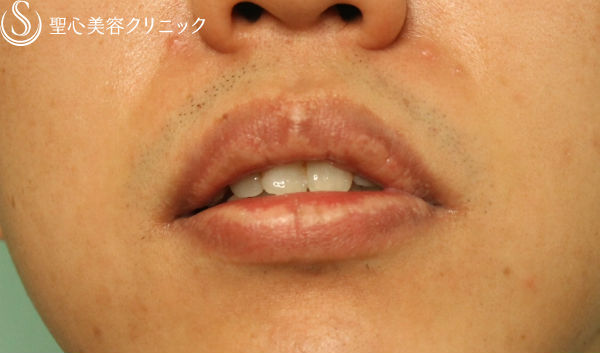 30代男性 唇フォアダイス 電気凝固術 症例写真 美容整形 美容外科なら聖心美容クリニック