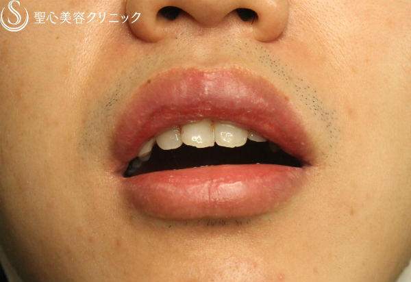 【30代男性】唇フォアダイス（電気凝固術） After 