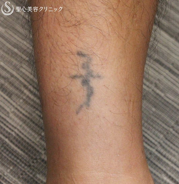 40代男性 タトゥー除去 Qスイッチyagレーザー 4ヶ月 症例写真 美容整形 美容外科なら聖心美容クリニック 40代男性 タトゥー除去 Qスイッチyagレーザー 4ヶ月 症例写真 美容整形 美容外科なら聖心美容クリニック