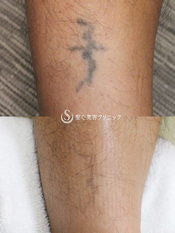 【40代男性・タトゥー除去】QスイッチYAGレーザー（4ヶ月） After 