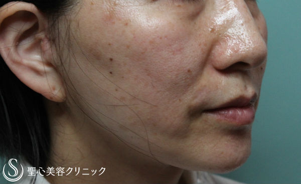 【女性・口横のたるみを改善】フェイスリフト＆脂肪吸引（1ヶ月半後） After 