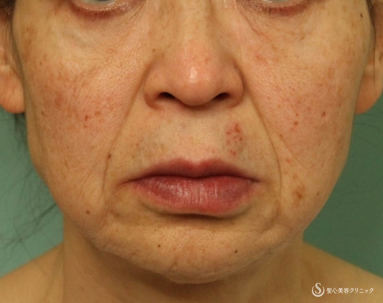 60代女性 しっかりとしたタルミ治療 フルフェイスリフト リガメント処置 Smas処置 症例写真 美容整形 美容外科なら聖心美容クリニック 60代女性 しっかりとしたタルミ治療 フルフェイスリフト リガメント処置 Smas処置 症例写真 美容整形 美容外科なら聖心美容クリニック