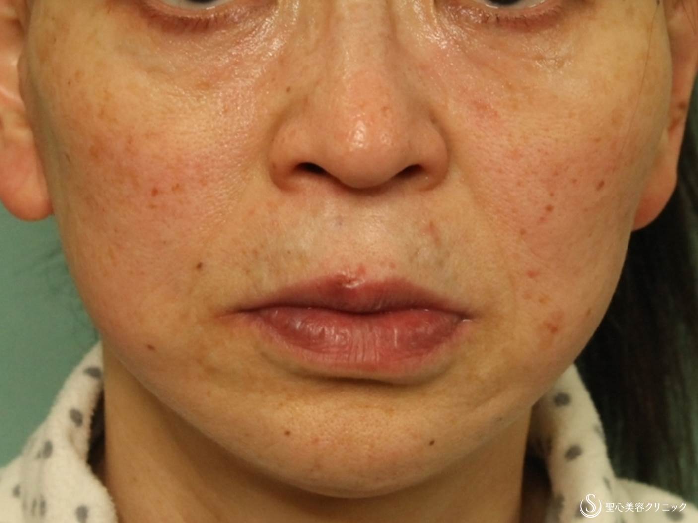 60代女性 しっかりとしたタルミ治療 フルフェイスリフト リガメント処置 Smas処置 症例写真 美容整形 美容外科なら聖心美容クリニック 60代女性 しっかりとしたタルミ治療 フルフェイスリフト リガメント処置 Smas処置 症例写真 美容整形 美容外科なら聖心美容クリニック