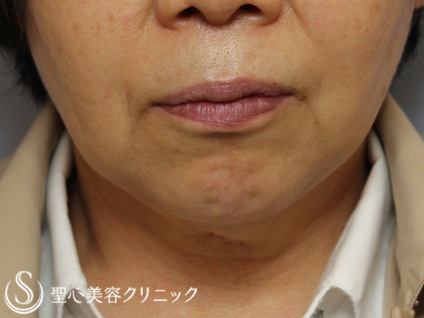 【60代女性・頬のたるみを改善】輪郭注射（5回処置後） After 