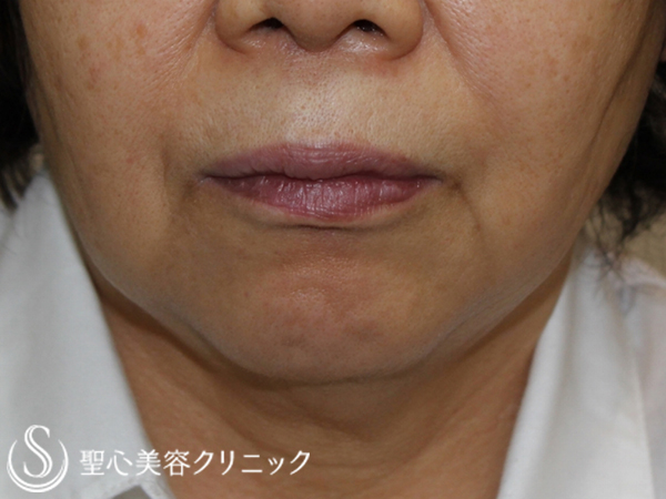 【60代女性・頬のたるみを改善】輪郭注射（5回処置後） Before 