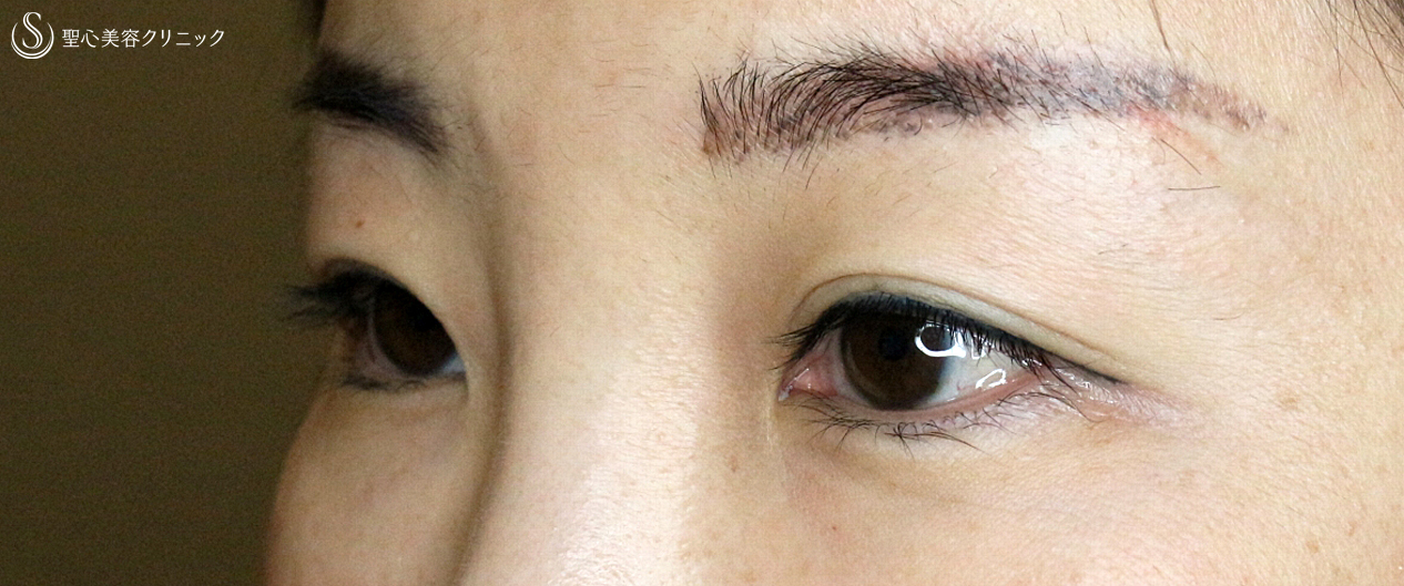 【30代女性・他院埋没法抜糸＆華やかな二重】二重全切開+α法＆目頭切開（2ヶ月後）札幌院 Before 