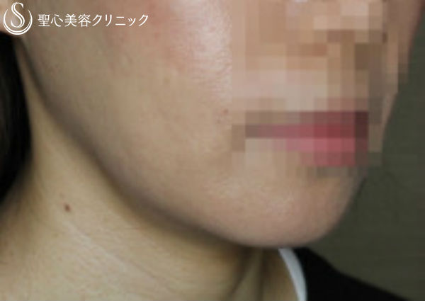 【30代女性・顎下がスッキリ】輪郭注射（3回後） After 