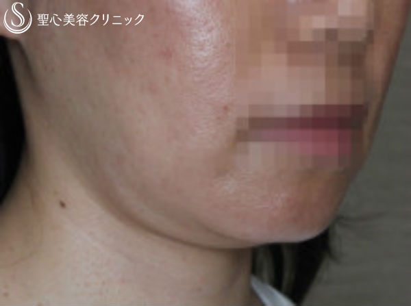 【30代女性・顎下がスッキリ】輪郭注射（3回後） Before 