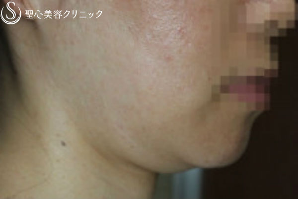 【30代女性・顎下がスッキリ】輪郭注射（3回後） Before 