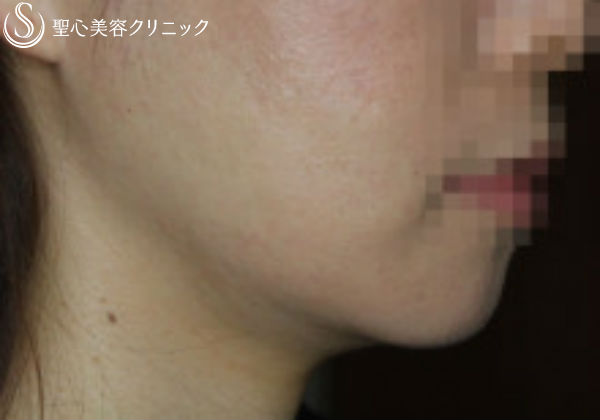 【30代女性・顎下がスッキリ】輪郭注射（3回後） After 