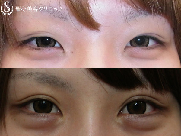 【女性・しっかりとした二重】二重切開法＋目頭切開（術後5年） After 