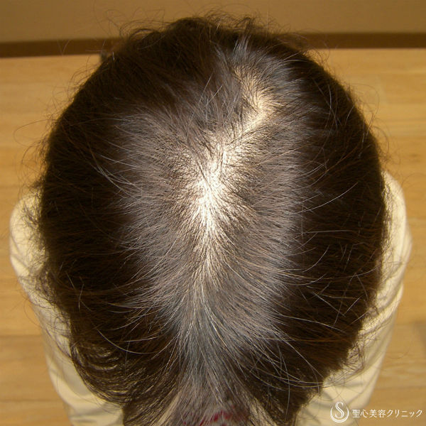 【40代女性・びまん性脱毛】グロースファクター毛髪再生療法（8回後） Before 