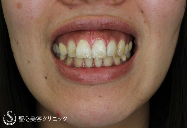 【30代女性・ガミースマイルの改善】歯肉短縮術（術後1ヶ月） Before 