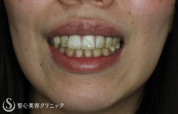 【30代女性・ガミースマイルの改善】歯肉短縮術（術後1ヶ月） After 