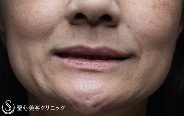 【40代女性・ほうれい線の自然な若返り】プレミアムPRP皮膚再生療法（3ヶ月後） Before 