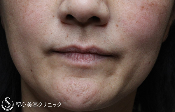 【40代女性・ほうれい線の自然な若返り】プレミアムPRP皮膚再生療法（3ヶ月後） After 