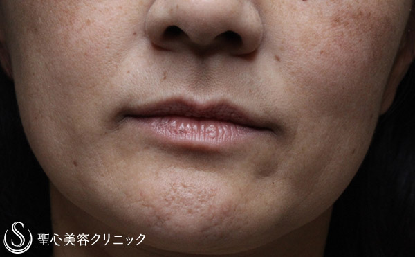 【40代女性・ほうれい線の自然な若返り】プレミアムPRP皮膚再生療法（3ヶ月後） Before 